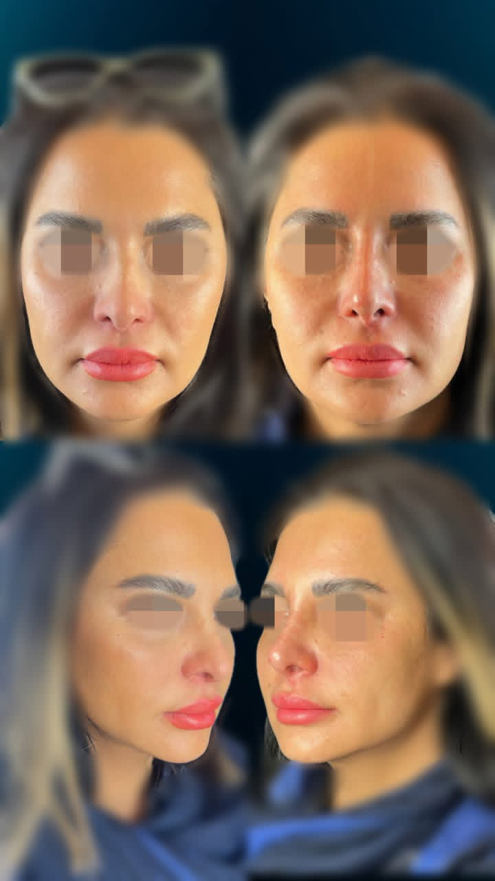 گالری آواتار بینی - تصویر 18