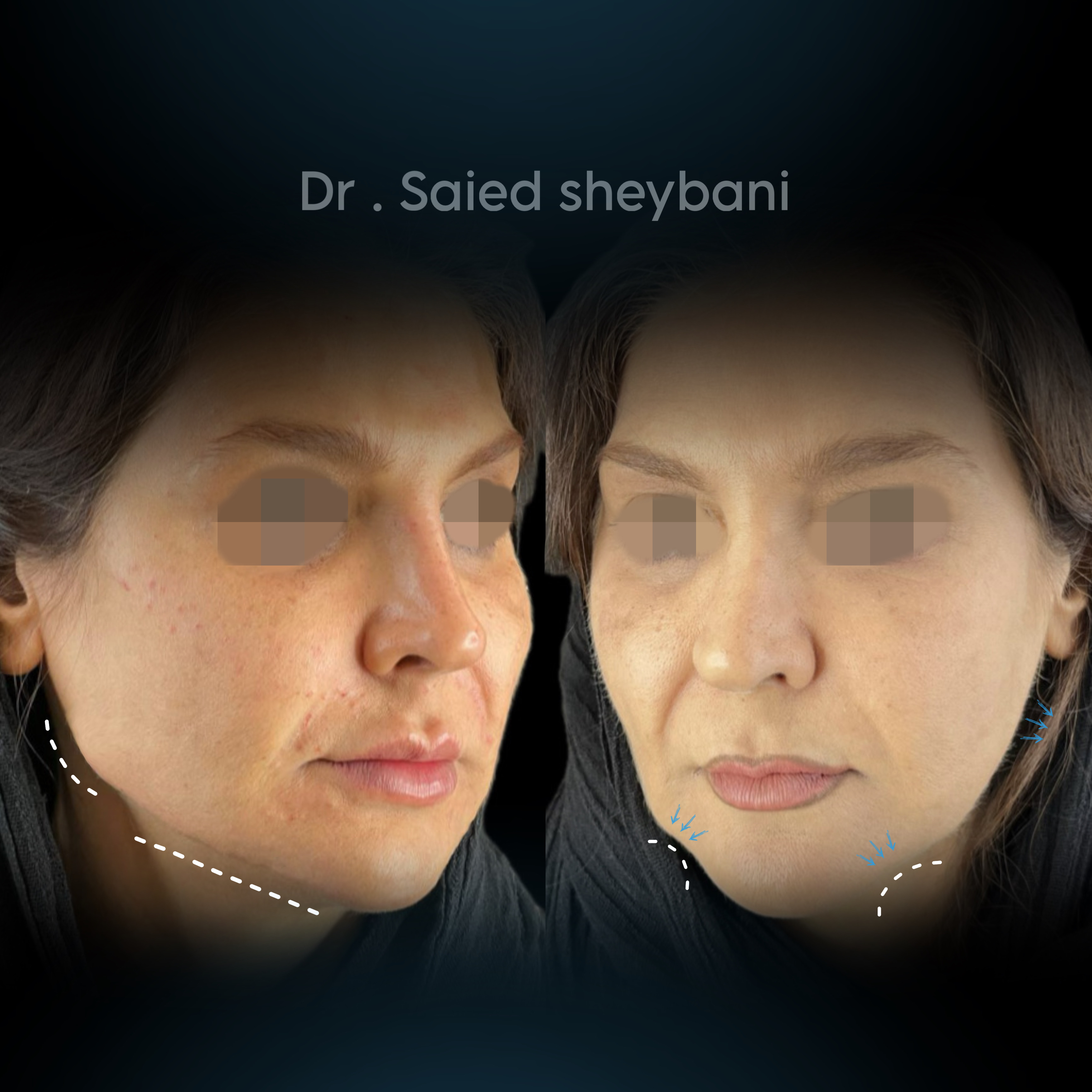 گالری Down Lift - تصویر 3